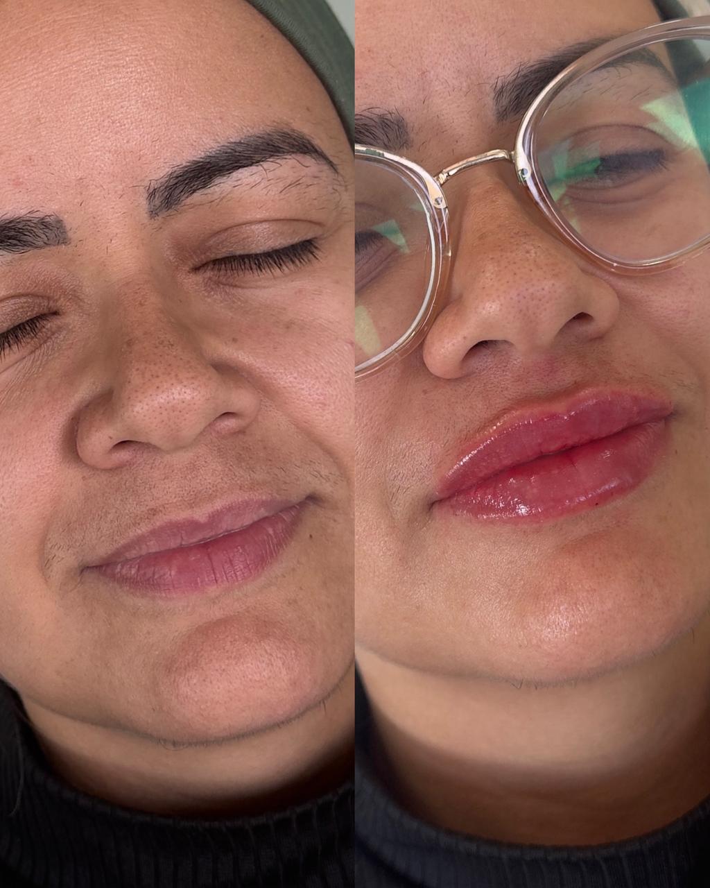 Preenchimento Labial - Antes e Depois