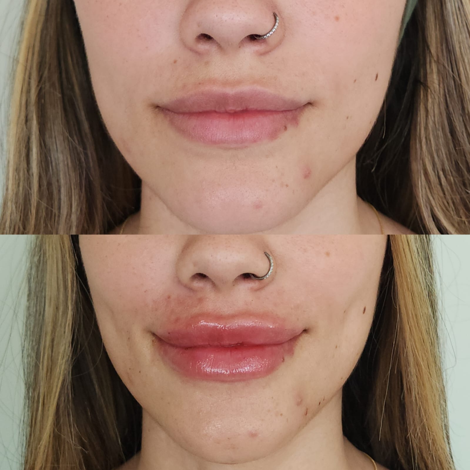 Preenchimento Labial - Antes e Depois