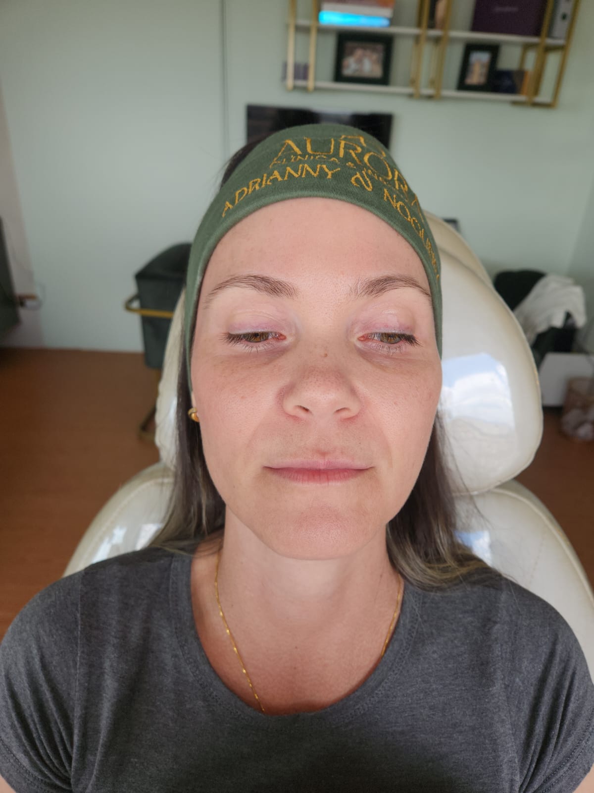 Antes do preenchimento labial - Dra. Tati Mayumi