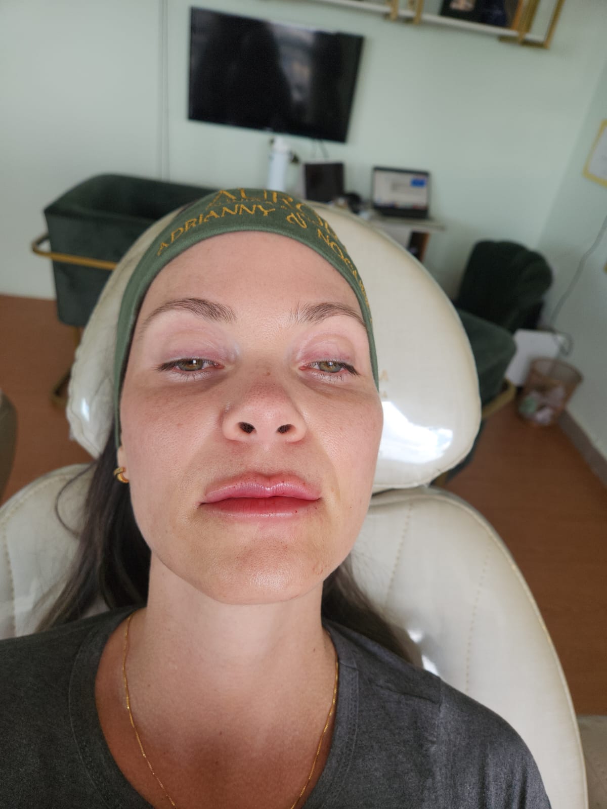 Depois do preenchimento labial - Dra. Tati Mayumi